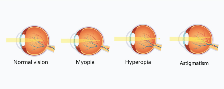 Comparison of refractive errors to normal vision.
