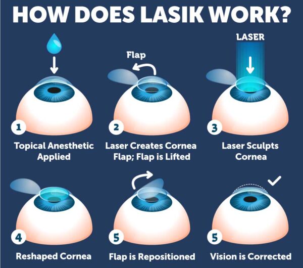 LASIK in 6 easy steps